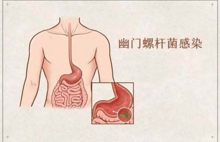 辟謠 | 吃大蒜能殺幽門螺桿菌？真的假的？