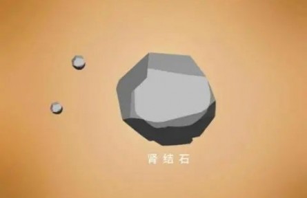 辟謠|腎結(jié)石患者不能補(bǔ)鈣？菠菜燉豆腐都不能吃了？
