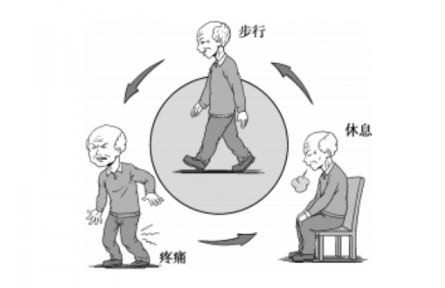 健康問答|什么是間歇性跛行？
