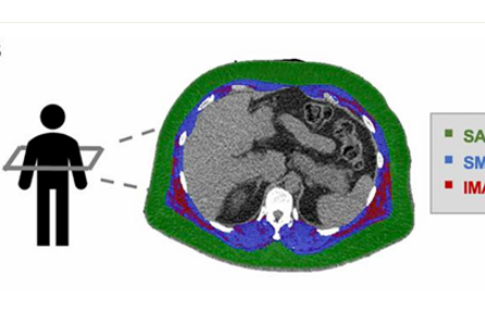 骨骼肌肌間脂肪多，心血管病風(fēng)險高